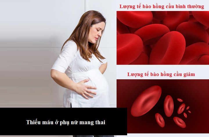 Anemia-During-Pregnancy